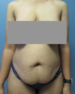 Abdominoplasty (Tummy Tuck) Before and After Pictures