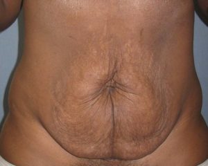 Abdominoplasty (Tummy Tuck) Before and After Pictures