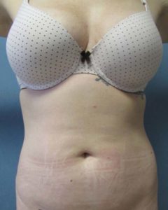 Liposuction Before and After Pictures