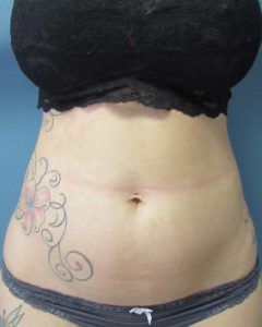 Liposuction Before and After Pictures