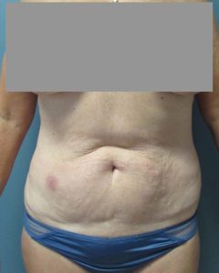 Liposuction Before and After Pictures