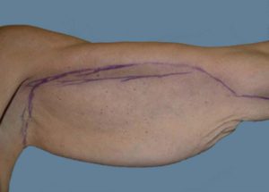 Brachioplasty (Arm Lift) Before and After Pictures