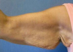 Brachioplasty (Arm Lift) Before and After Pictures