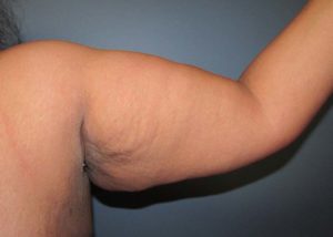 Brachioplasty (Arm Lift) Before and After Pictures