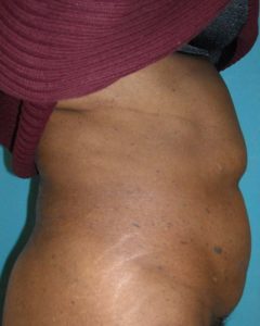 Abdominoplasty (Tummy Tuck) Before and After Pictures