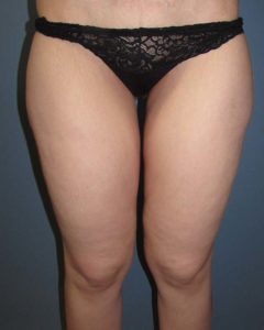 Thighplasty (Thigh Lift) Before and After Pictures