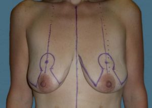 Breast Lift (Mastopexy) Before and After Pictures