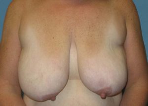 Breast Lift (Mastopexy) Before and After Pictures