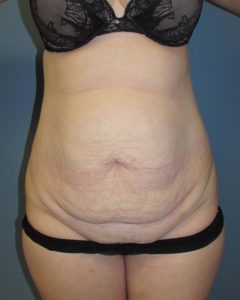 Abdominoplasty (Tummy Tuck) Before and After Pictures