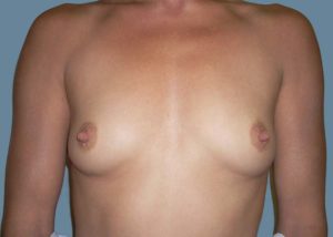 Breast Augmentation Before and After Pictures