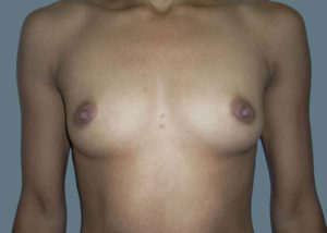 Breast Augmentation Before and After Pictures