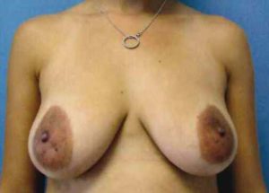 Breast Augmentation Before and After Pictures