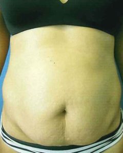 Abdominoplasty (Tummy Tuck) Before and After Pictures