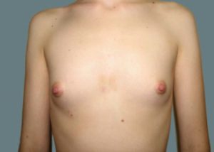 Breast Augmentation Before and After Pictures