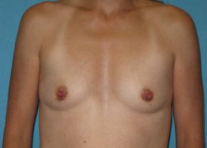 Breast Augmentation Before and After Pictures