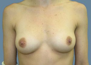 Breast Augmentation Before and After Pictures