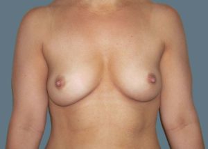 Breast Augmentation Before and After Pictures