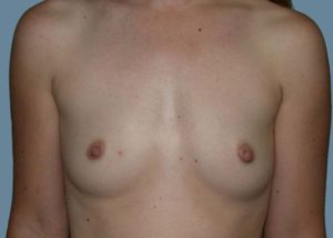 Breast Augmentation Before and After Pictures