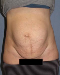 Abdominoplasty (Tummy Tuck) Before and After Pictures