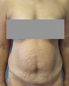 Abdominoplasty (Tummy Tuck) Before and After Pictures