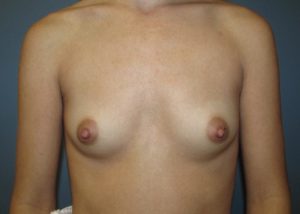 Breast Augmentation Before and After Pictures