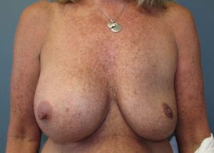 Breast Implant Revision Before and After Pictures