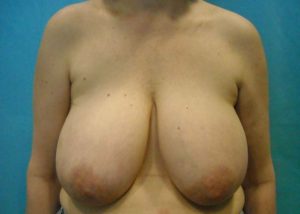 Breast Reduction Before and After Pictures