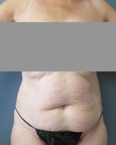 Abdominoplasty (Tummy Tuck) Before and After Pictures