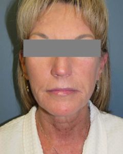 Facelift Before and After Pictures