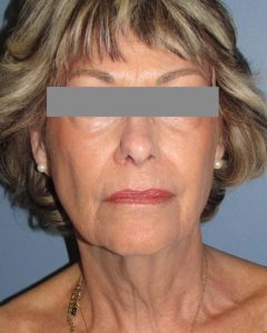 Facelift Before and After Pictures