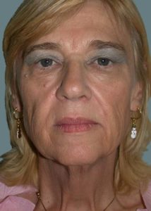 Facelift Before and After Pictures