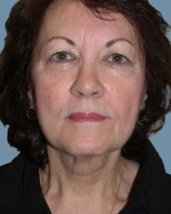 Facelift Before and After Pictures