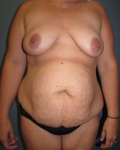 Abdominoplasty (Tummy Tuck) Before and After Pictures