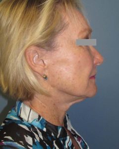 Facelift Before and After Pictures