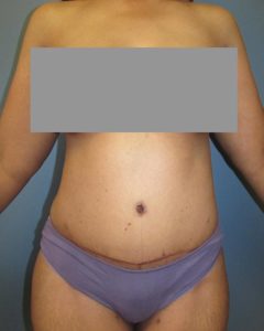 Abdominoplasty (Tummy Tuck) Before and After Pictures