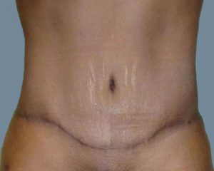 Abdominoplasty (Tummy Tuck) Before and After Pictures