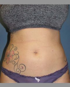 Liposuction Before and After Pictures
