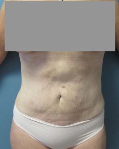 Liposuction Before and After Pictures