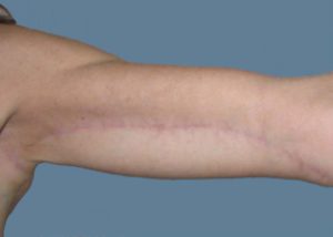 Brachioplasty (Arm Lift) Before and After Pictures