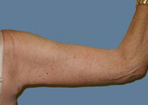 Brachioplasty (Arm Lift) Before and After Pictures