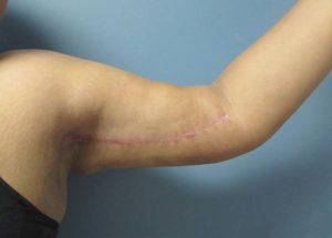 Brachioplasty (Arm Lift) Before and After Pictures