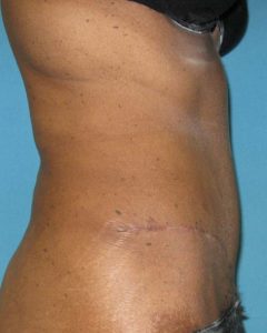 Abdominoplasty (Tummy Tuck) Before and After Pictures