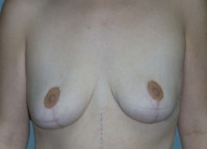 Breast Lift (Mastopexy) Before and After Pictures