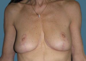 Breast Lift (Mastopexy) Before and After Pictures