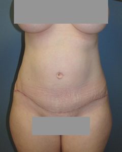 Abdominoplasty (Tummy Tuck) Before and After Pictures