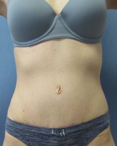 Abdominoplasty (Tummy Tuck) Before and After Pictures