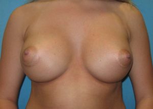 Breast Augmentation Before and After Pictures