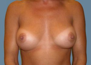 Breast Augmentation Before and After Pictures