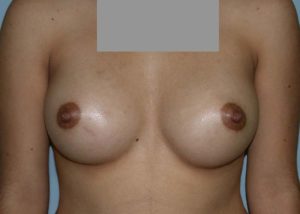 Breast Augmentation Before and After Pictures