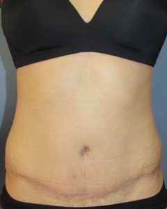 Abdominoplasty (Tummy Tuck) Before and After Pictures